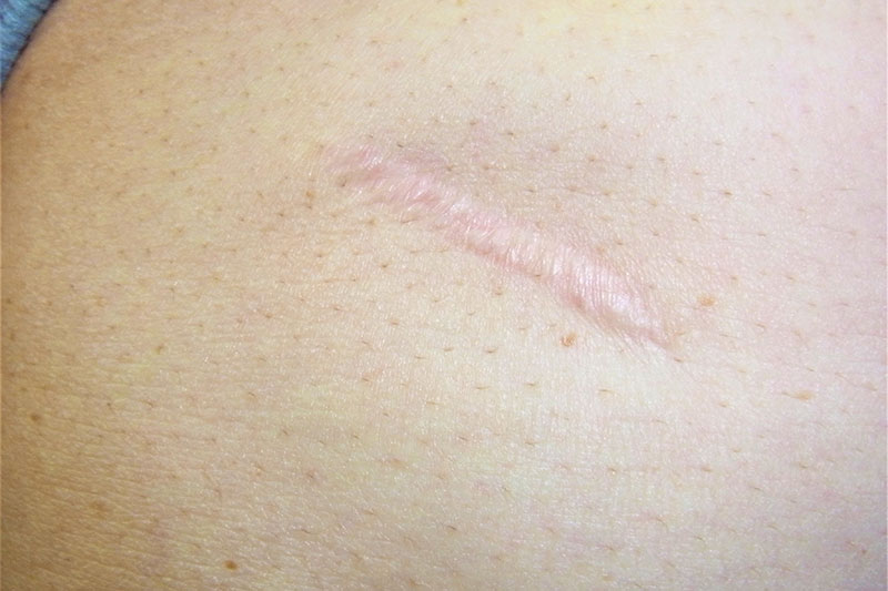 瘢痕、ケロイド